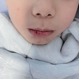 兒子被推跌嘴唇撞裂，我只用薰衣草就幫他止血了! *(內文有真實照片)